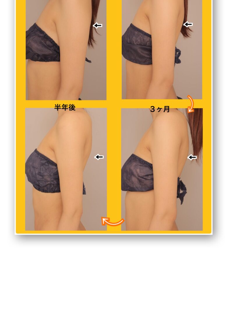 完全時系列でお見せします。腕の「後ろ側」の細さに技術力の差がでます。お任せください。～25歳172cm52kg上腕肩脇肉900cc吸引後完全時系列（1，3, 6ヶ月）～