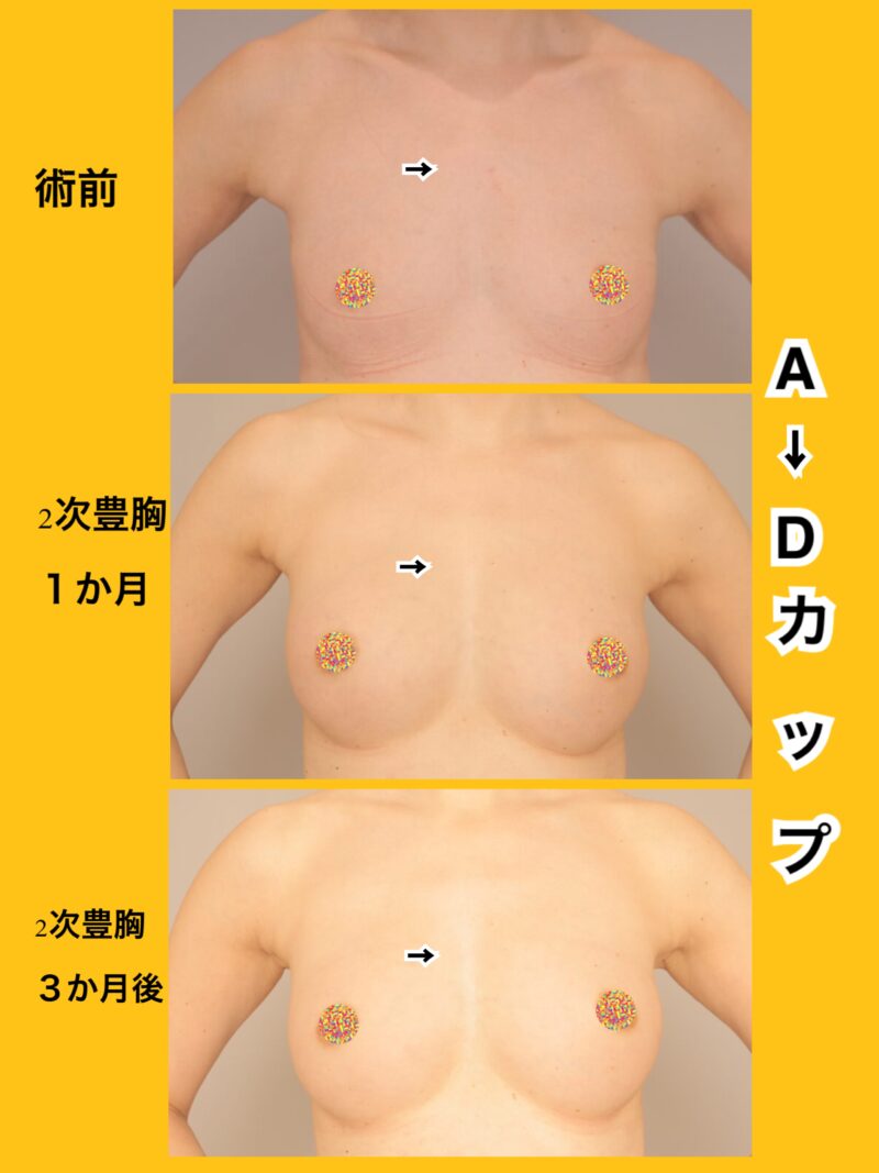 A→Dカップに!時系列でお見せします。 ~脂肪豊胸(CRF豊胸)2次豊胸後1ヶ月3ヶ月~