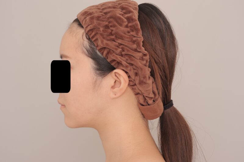 最高峰の垢抜けできます。「おでこ丸く」+「フェイスラインすっきり」 ~25歳155cm48kgおでここめかみ脂肪注入+頬顎下脂肪吸引後3か月~