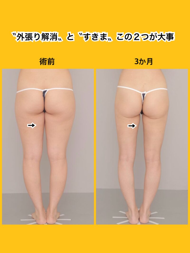 太もも上部のすきまにこだわる～22歳151cm48kg太もも全周膝臀部1900cc 吸引後３か月～