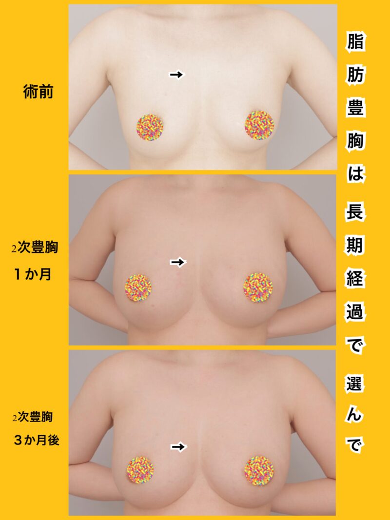 時系列で。大きさと形どちらもこだわる脂肪豊胸～40歳162cm56kg脂肪豊胸（CRF豊胸）２次豊胸後１か月３か月～