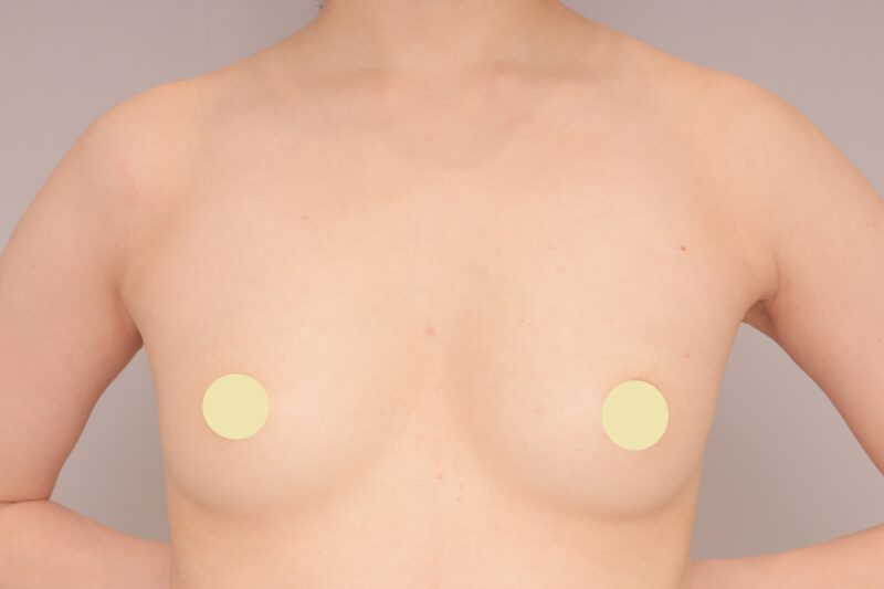 ベイザー脂肪吸引（１ヶ月経過：32）の術前写真