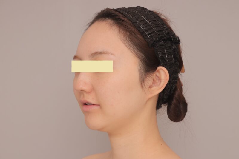 ベイザー脂肪吸引（３ヶ月経過：29）の術前写真