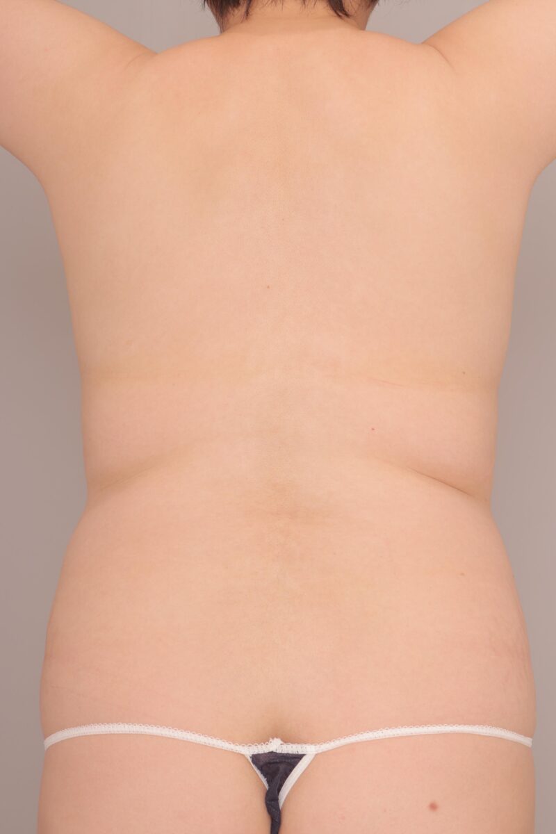 ベイザー脂肪吸引（術後３ヶ月経過：45）の術前写真