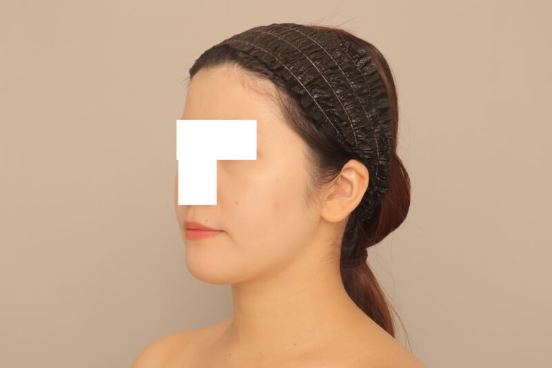 ベイザー脂肪吸引(半年経過:29)の術後写真