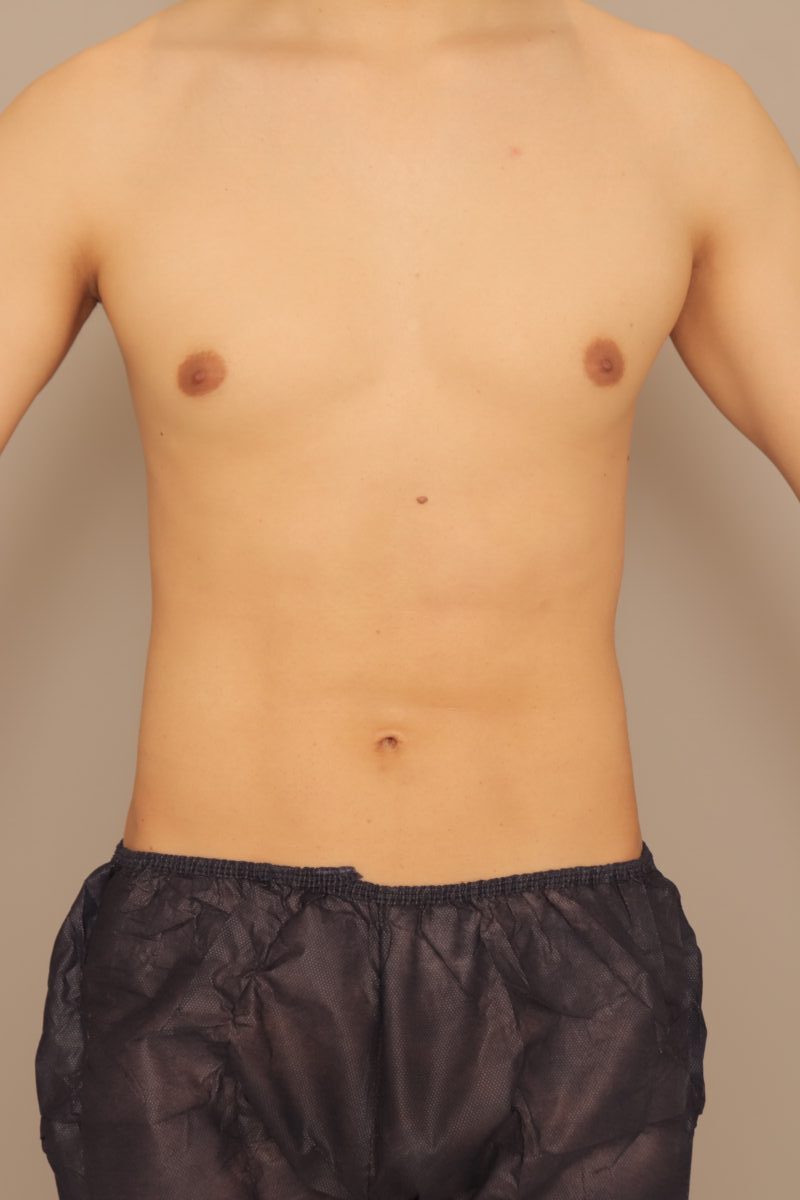 ベイザー脂肪吸引(半年経過:29)の術後写真