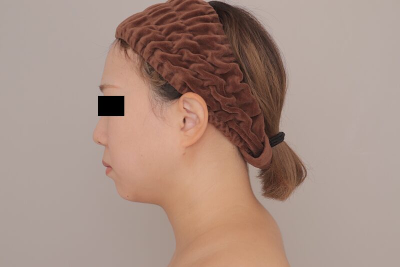 ベイザー脂肪吸引（3ヶ月経過：29）の術後写真