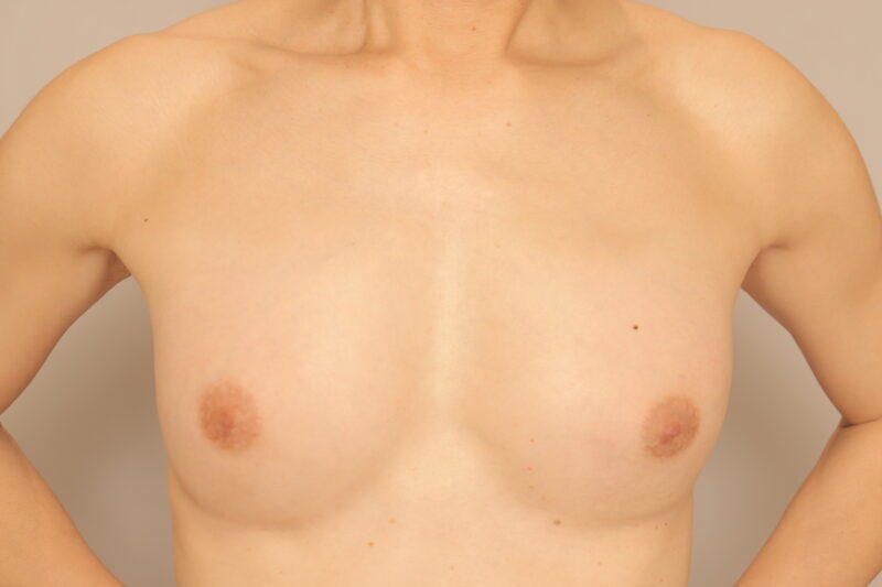 50代男性豊胸！脂肪のお引越しはみんなの夢♡奇跡のふっくら美バストへ♡