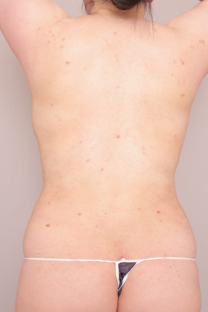 ベイザー脂肪吸引（１か月後経過：31）の術後写真