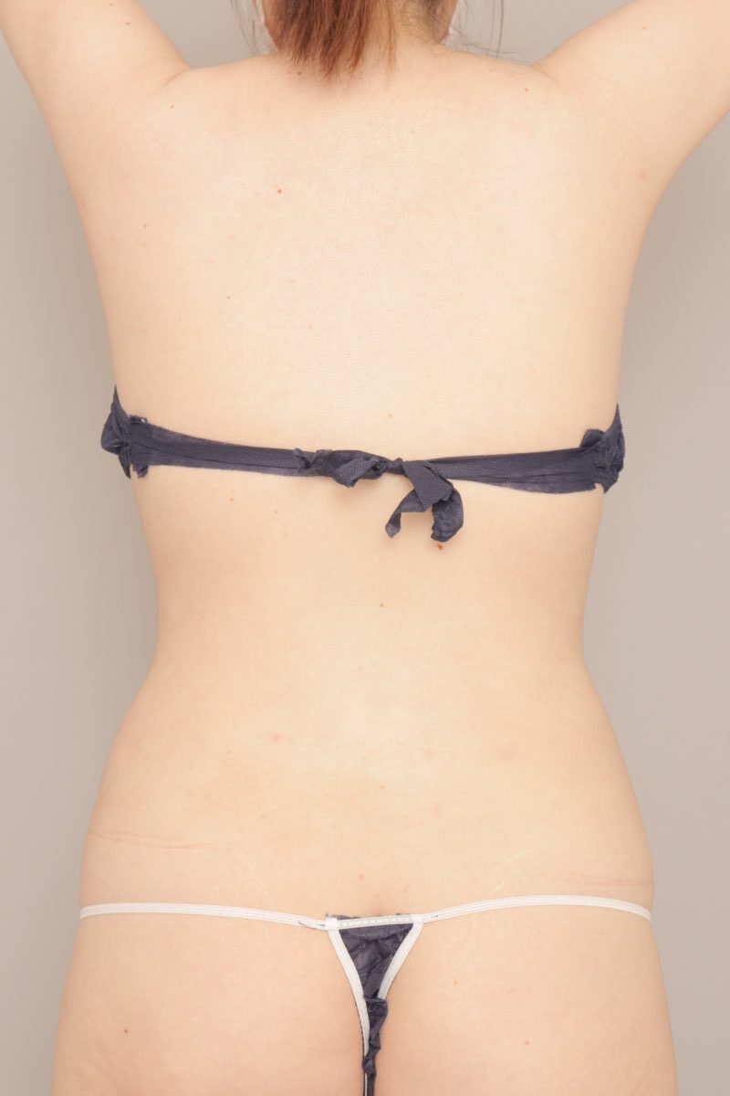 ２０代女性、BMI23.6の方。お腹と腰の脂肪吸引、３か月経過です。