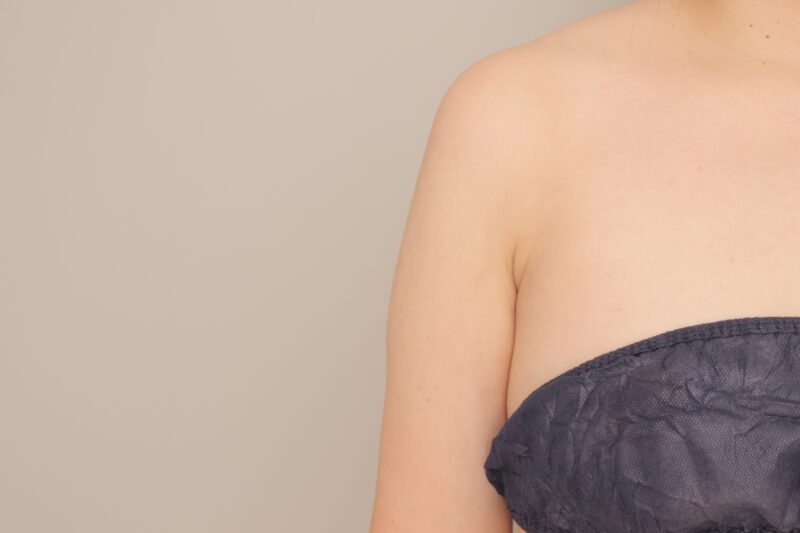 ２０代女性、上腕全周と脇肉の脂肪吸引の三か月経過です。