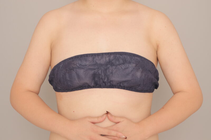 ベイザー脂肪吸引（3か月経過：25）の術後写真