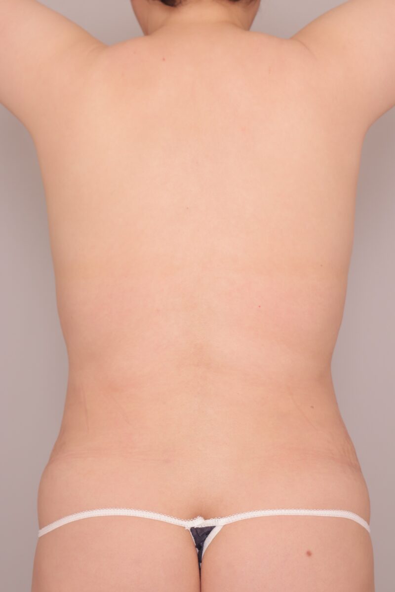 ベイザー脂肪吸引（術後３ヶ月経過：45）の術後写真