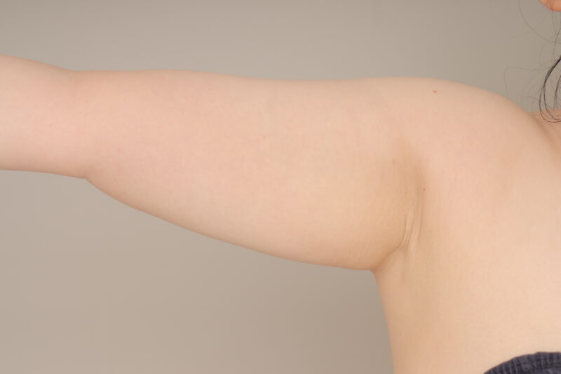 ベイザー脂肪吸引(6か月経過:38)の術前写真