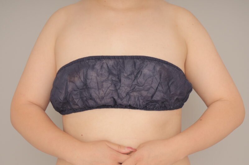 ベイザー脂肪吸引（3か月経過：25）の術前写真