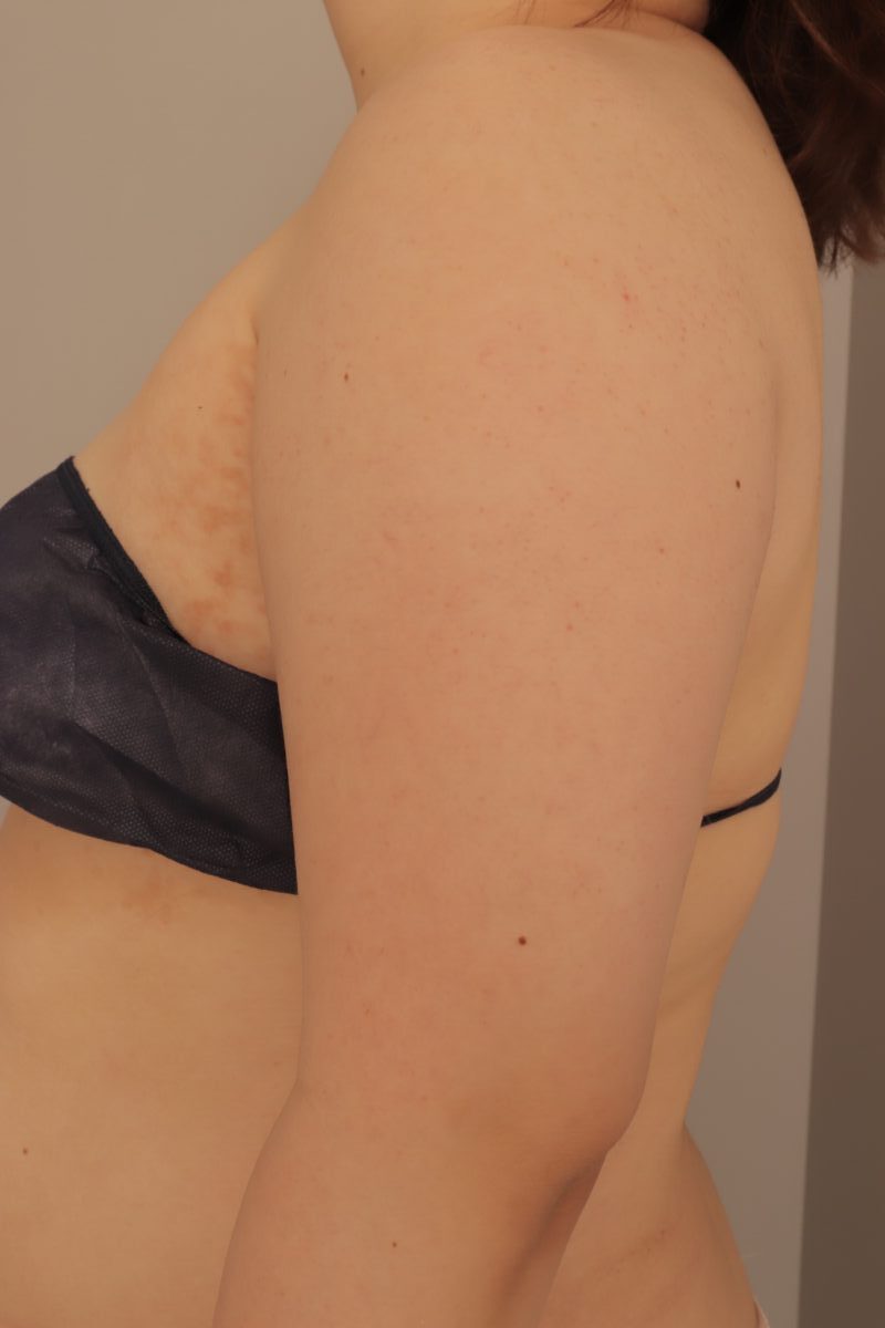 ベイザー脂肪吸引(半年経過:36)の術前写真