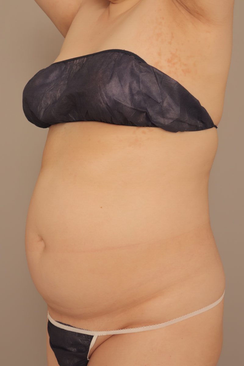 ベイザー脂肪吸引(半年経過:36)の術前写真