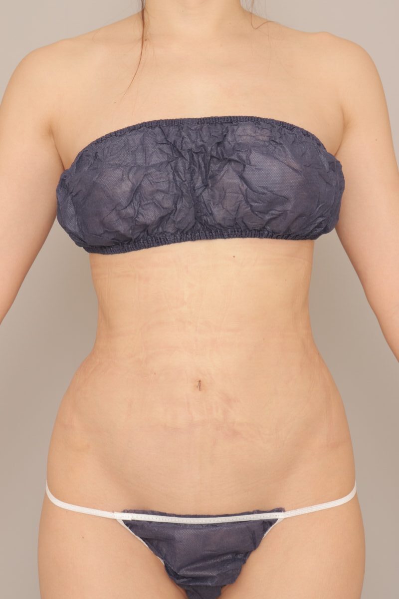 ベイザー脂肪吸引（１ヶ月経過：39）の術後写真