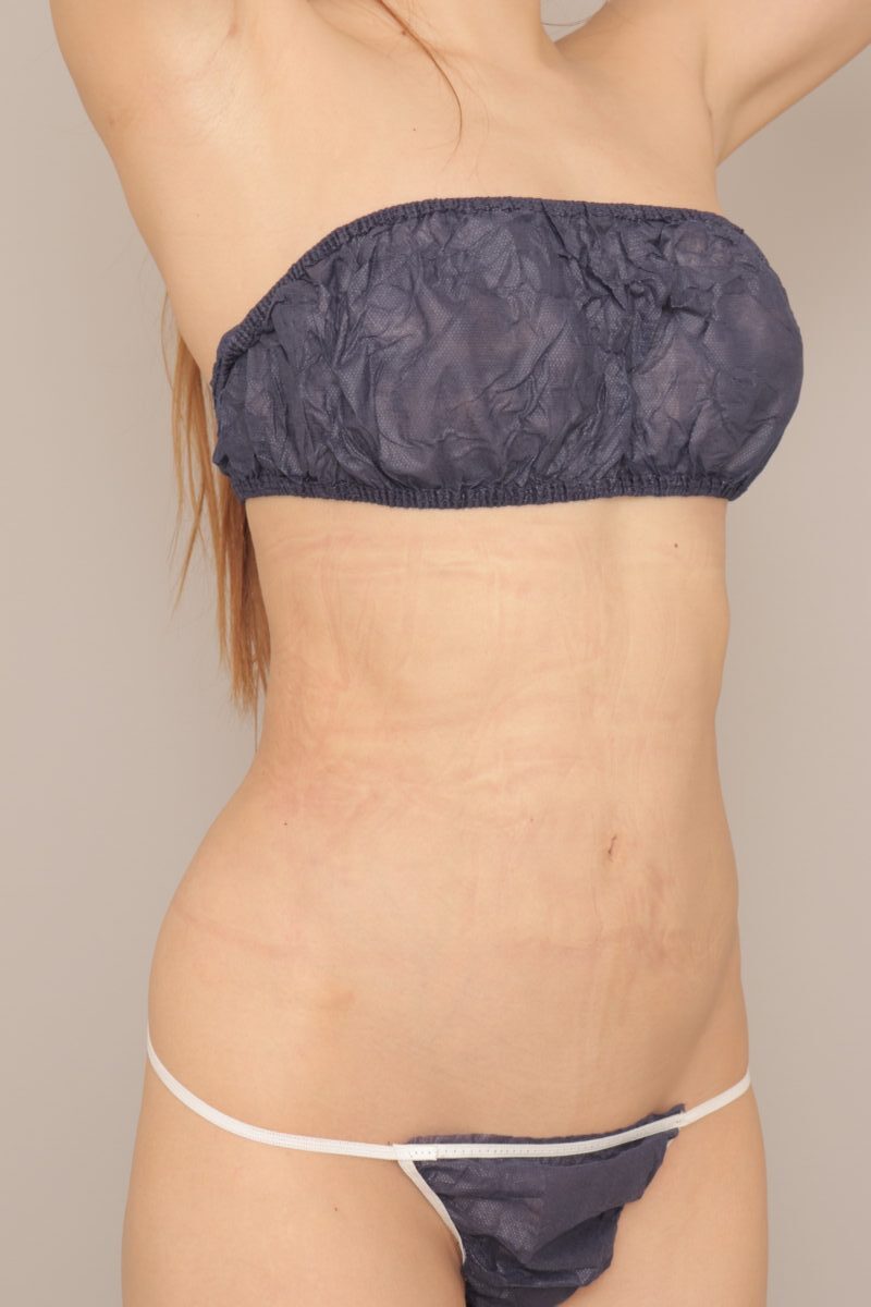 細身の女性の腹腰脂肪吸引、１か月経過のご紹介です。