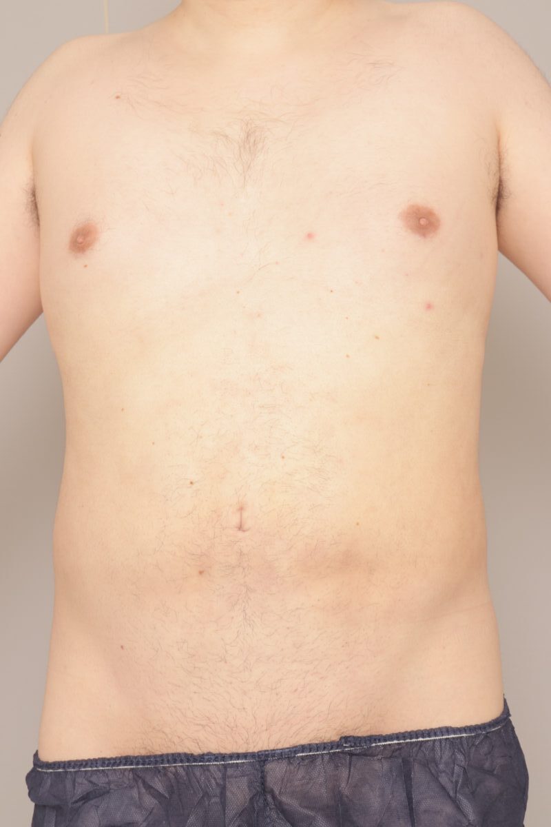 ベイザー脂肪吸引(1ヶ月経過:45)の術後写真