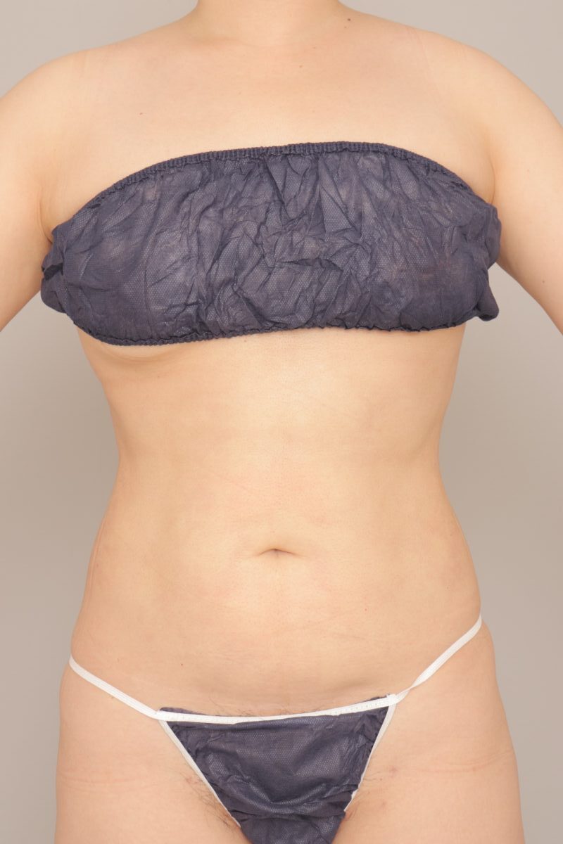 40代女性のお腹の脂肪吸引、３か月経過のご紹介です。