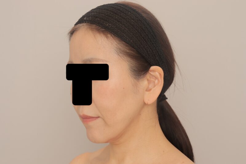 50代女性のお顔の脂肪吸引、３か月経過です