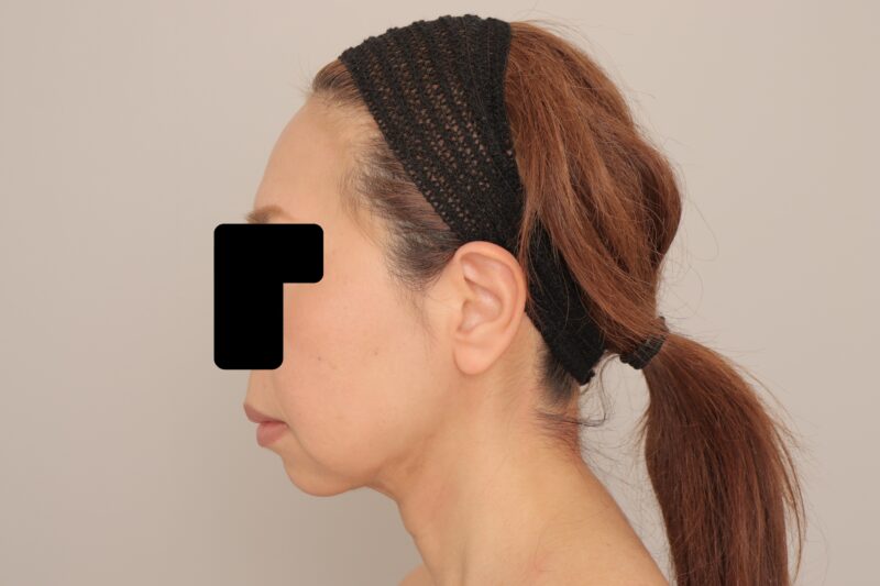 ベイザー脂肪吸引（１ヶ月経過：52）の術後写真