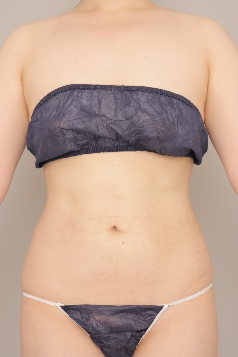 ベイザー脂肪吸引(3か月経過:25)の術後写真