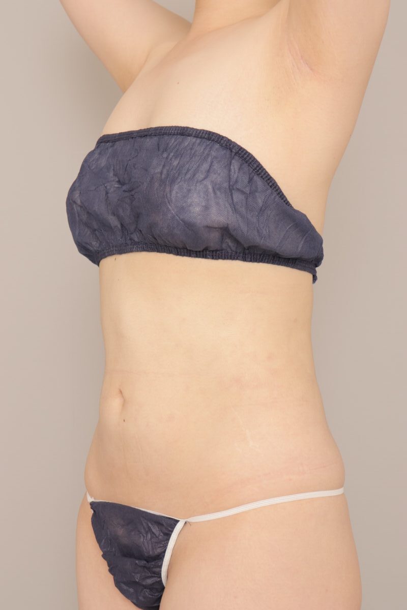 ２０代女性BMI24.4の方、お腹と腰の脂肪吸引、３か月経過です。