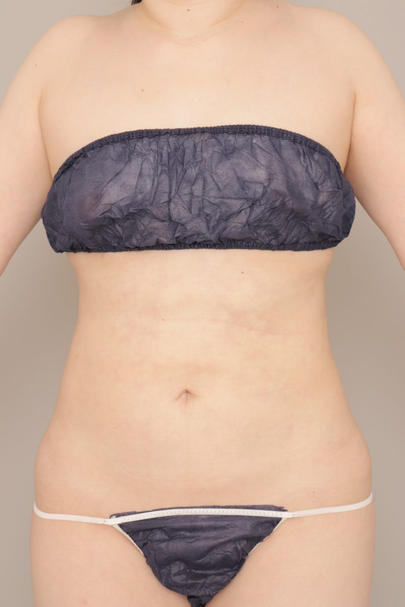 ベイザー脂肪吸引(6か月経過:38)の術後写真