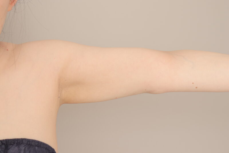 他院修正：二の腕の脂肪吸引も、おまかせください。嬉しいお言葉もいただきました。