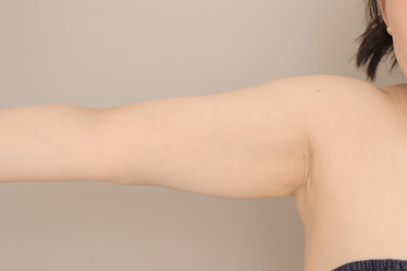 ベイザー脂肪吸引(6か月経過:38)の術後写真