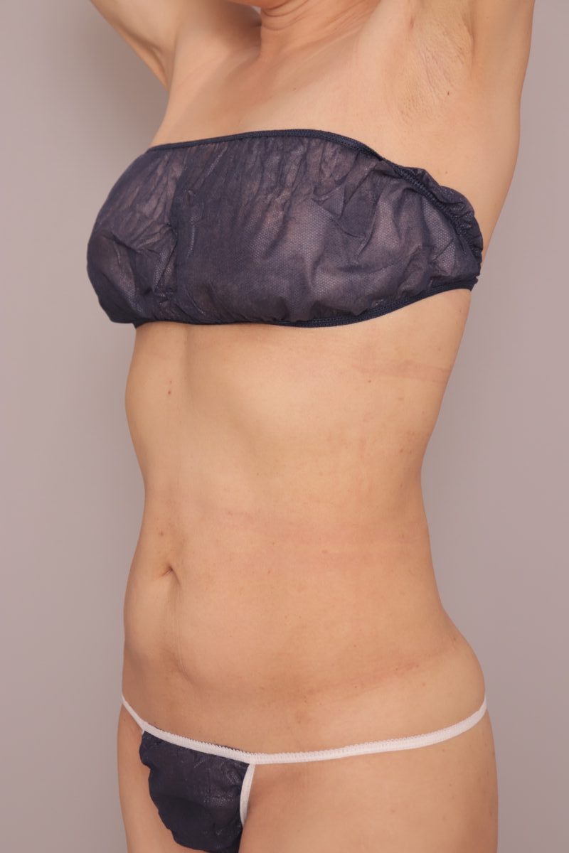 ベイザー脂肪吸引(半年経過:47)の術後写真