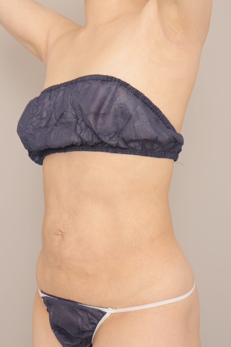 ベイザー脂肪吸引（3か月経過：35）の術後写真