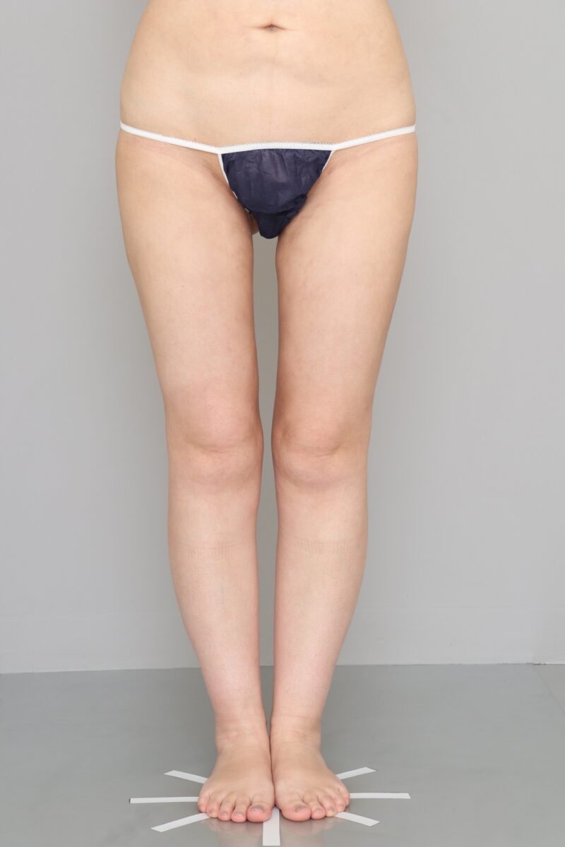 ベイザー脂肪吸引（４ヶ月経過：40）の術後写真