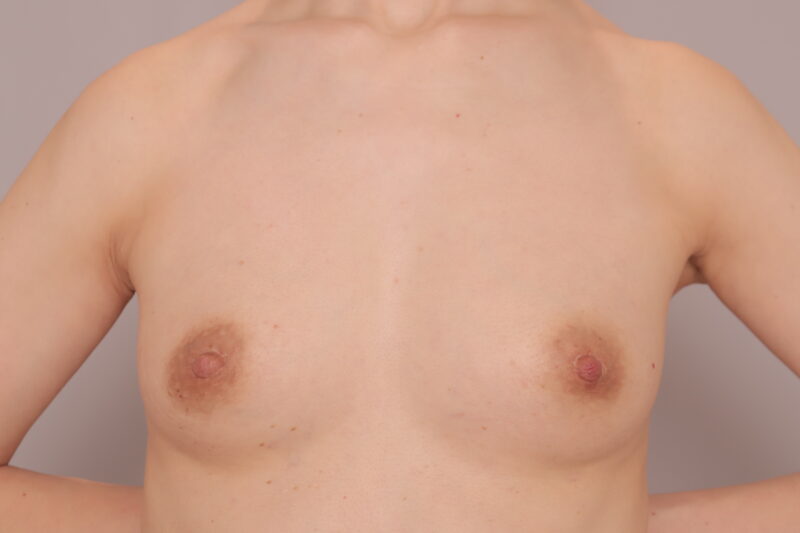 旦那様も大喜び♡ママさんのコンデンスリッチ豊胸&乳頭縮小半年後