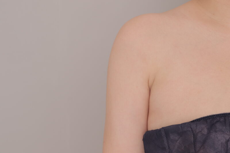 腕の大量吸引1か月後●