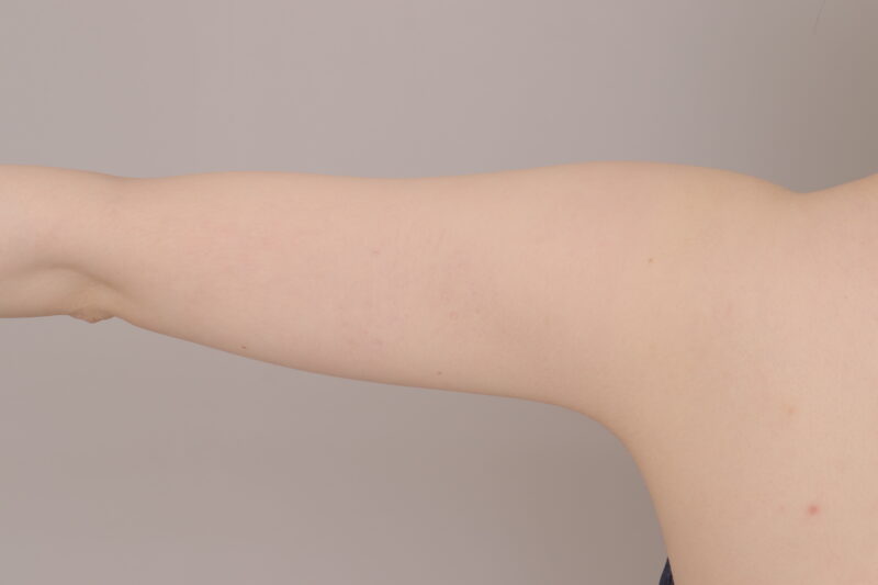 ベイザー脂肪吸引(3ヶ月経過:24)の術後写真