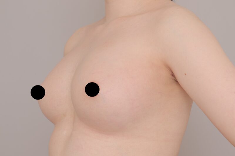 ベイザー脂肪吸引（3ヶ月経過：24）の術後写真