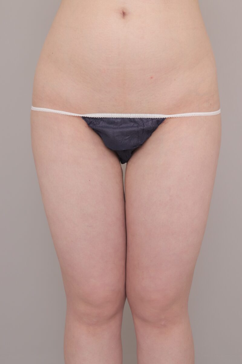 太もも大量吸引の1か月後