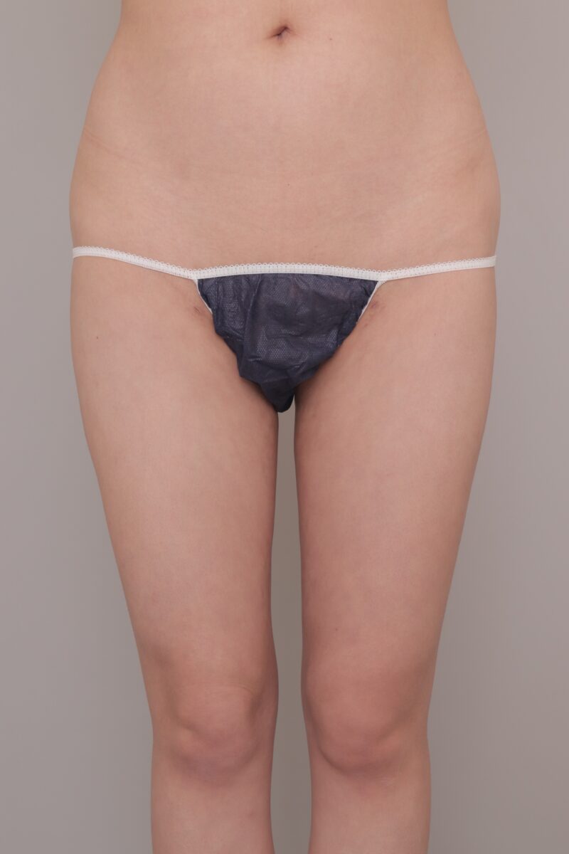 ベイザー脂肪吸引(1ヶ月経過:23)の術後写真