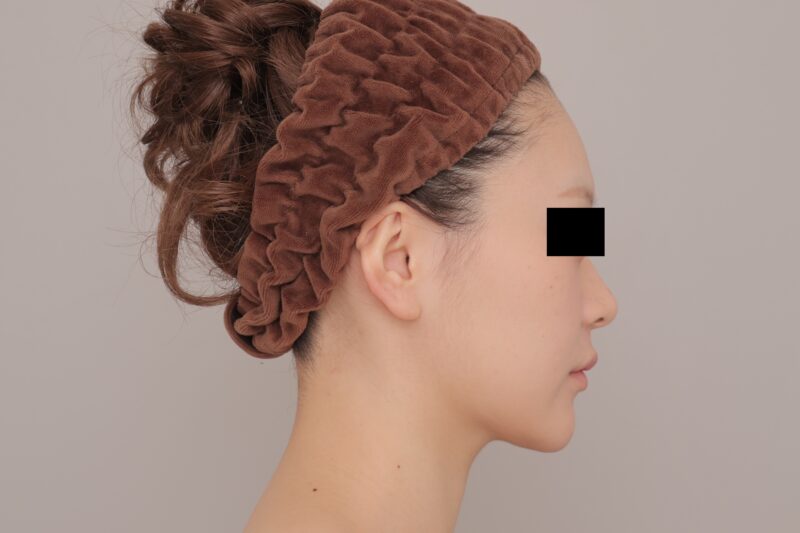 ベイザー脂肪吸引(3ヶ月経過:21)の術後写真