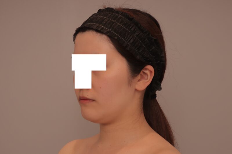 ベイザー脂肪吸引(半年経過:29)の術前写真