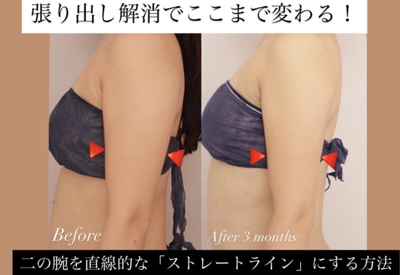 【二の腕＋肩】張り出し解消でここまで変わる！二の腕を直線的な「ストレートライン」にする方法