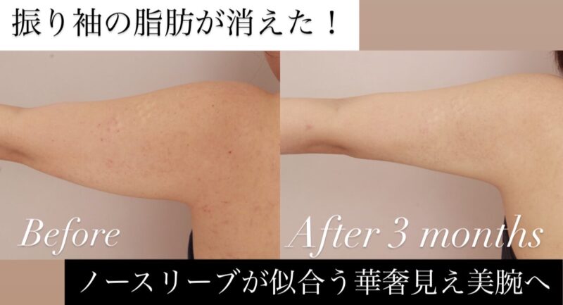 【劇的変化】振袖の脂肪が消えた！ノースリーブが似合う華奢見え美腕への軌跡