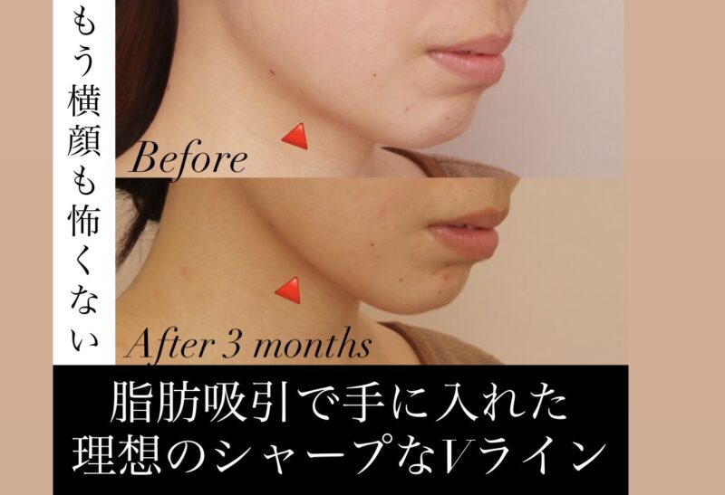 【もう横顔も怖くない！】脂肪吸引で手に入れた理想のシャープなVライン