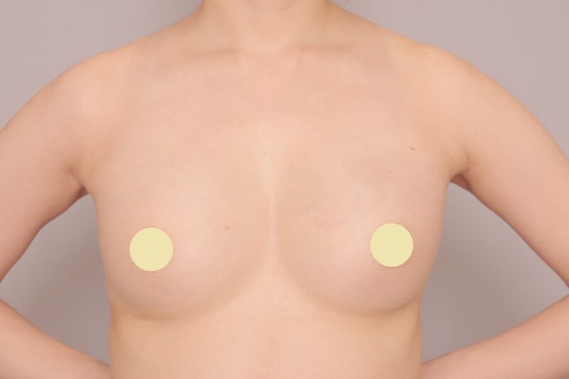 ベイザー脂肪吸引（１ヶ月経過：32）の術後写真