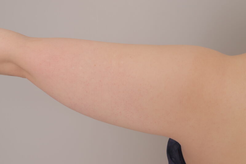 ベイザー脂肪吸引(1ヶ月経過:26)の術前写真