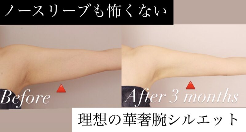 【ノースリーブも怖くない！】二の腕・肩の脂肪吸引で叶える理想の華奢見えシルエット！