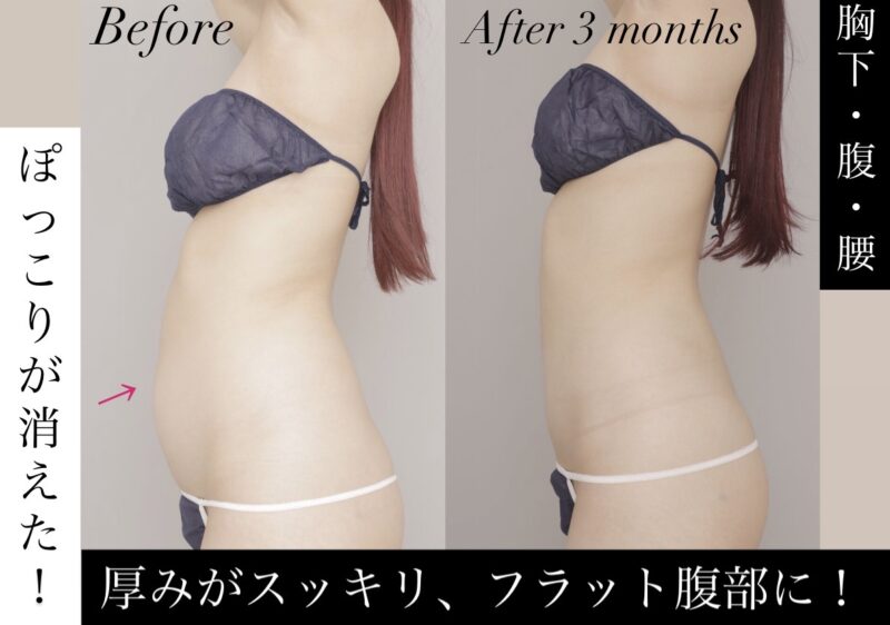 【「ぽっこり」が消えた！】厚みがスッキリと解消、劇的なフラット腹部に！